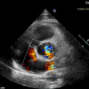 Case Sharing | Biodegradable ASD Closure Under TTE-Only Guidance in Anomalous Coronary Patient