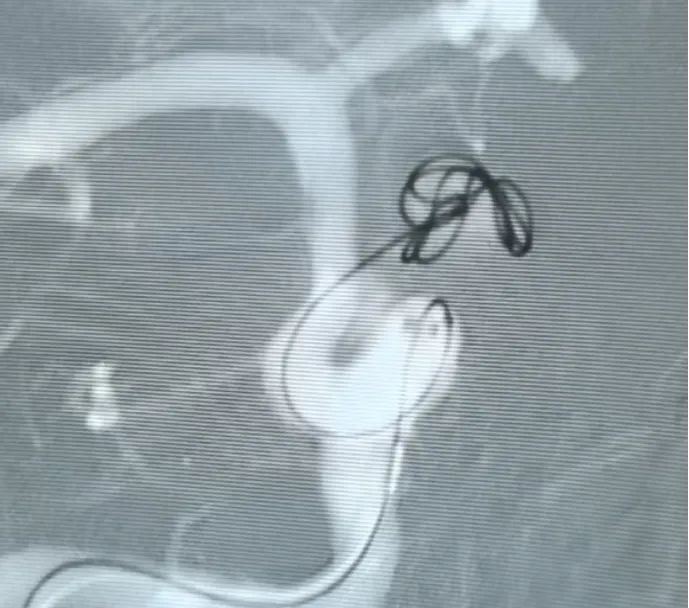 Clinical Spotlight | Nuva® Flow Diverter + Embolic Coils for Ophthalmic Segment ICA Aneurysm