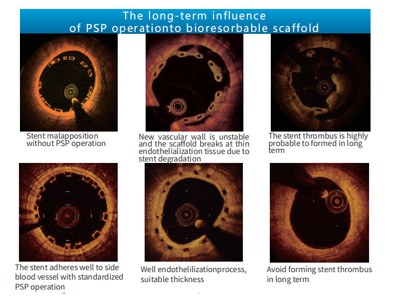 ictrue OCT Study on stent absorption in 3 years Product Details